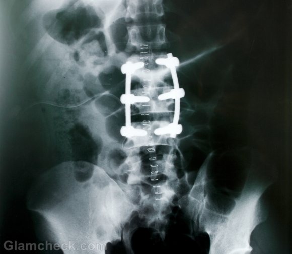 Spine Surgery Lowers Vitamin D & Hinders Recovery